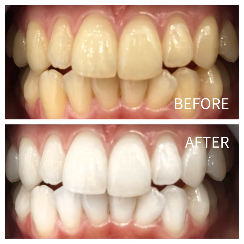 ホワイトニングのビフォアー・アフターNo.1