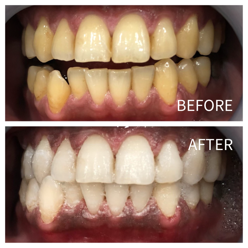 ホワイトニングのビフォアー・アフターNo.2