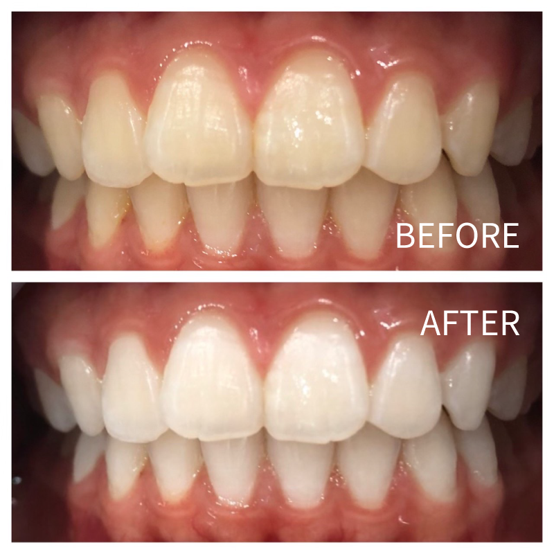ホワイトニングのビフォアー・アフターNo.3