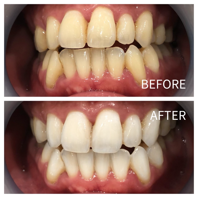 ホワイトニングのビフォアー・アフターNo.4