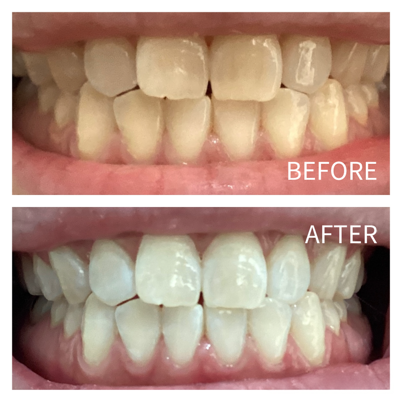 ホワイトニングのビフォアー・アフターNo.5